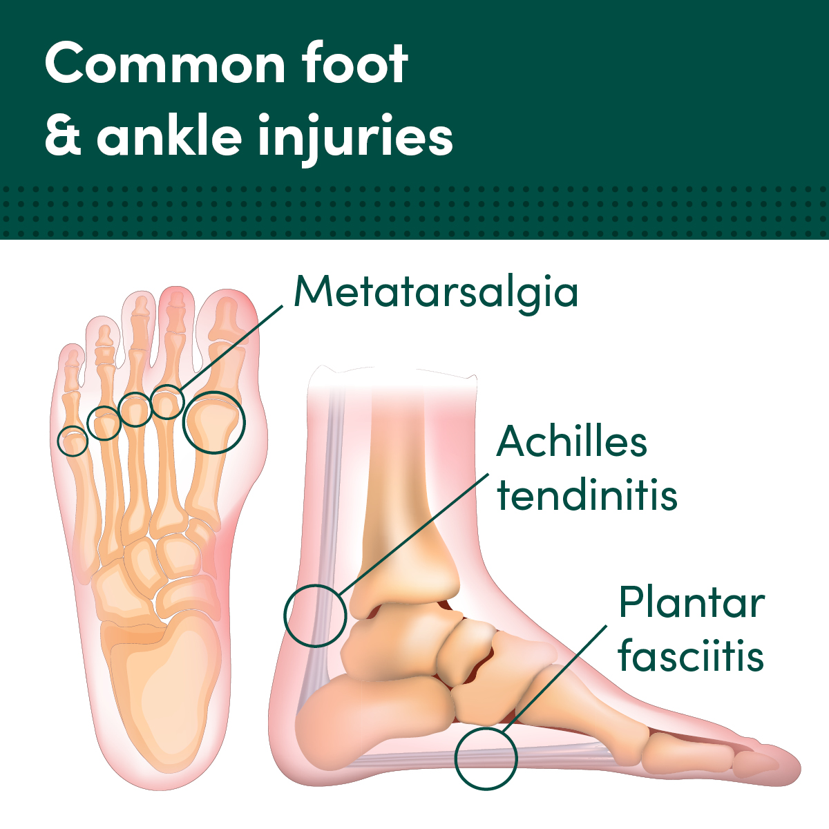 achilles tendon, plantar fascia and metatarsalgia graphic