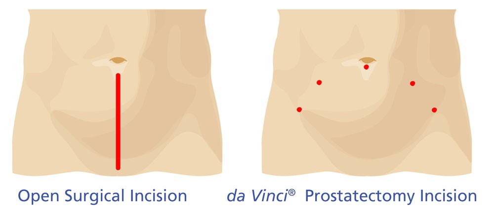 Incision comparison for da vinci